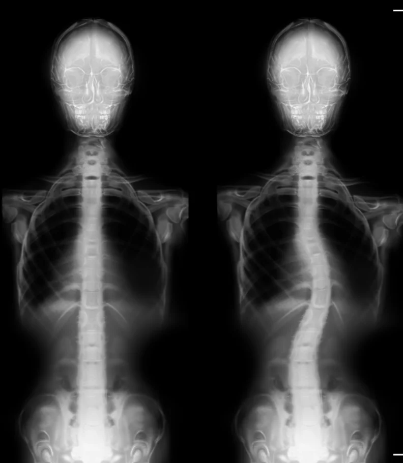 Scoliosis Westford